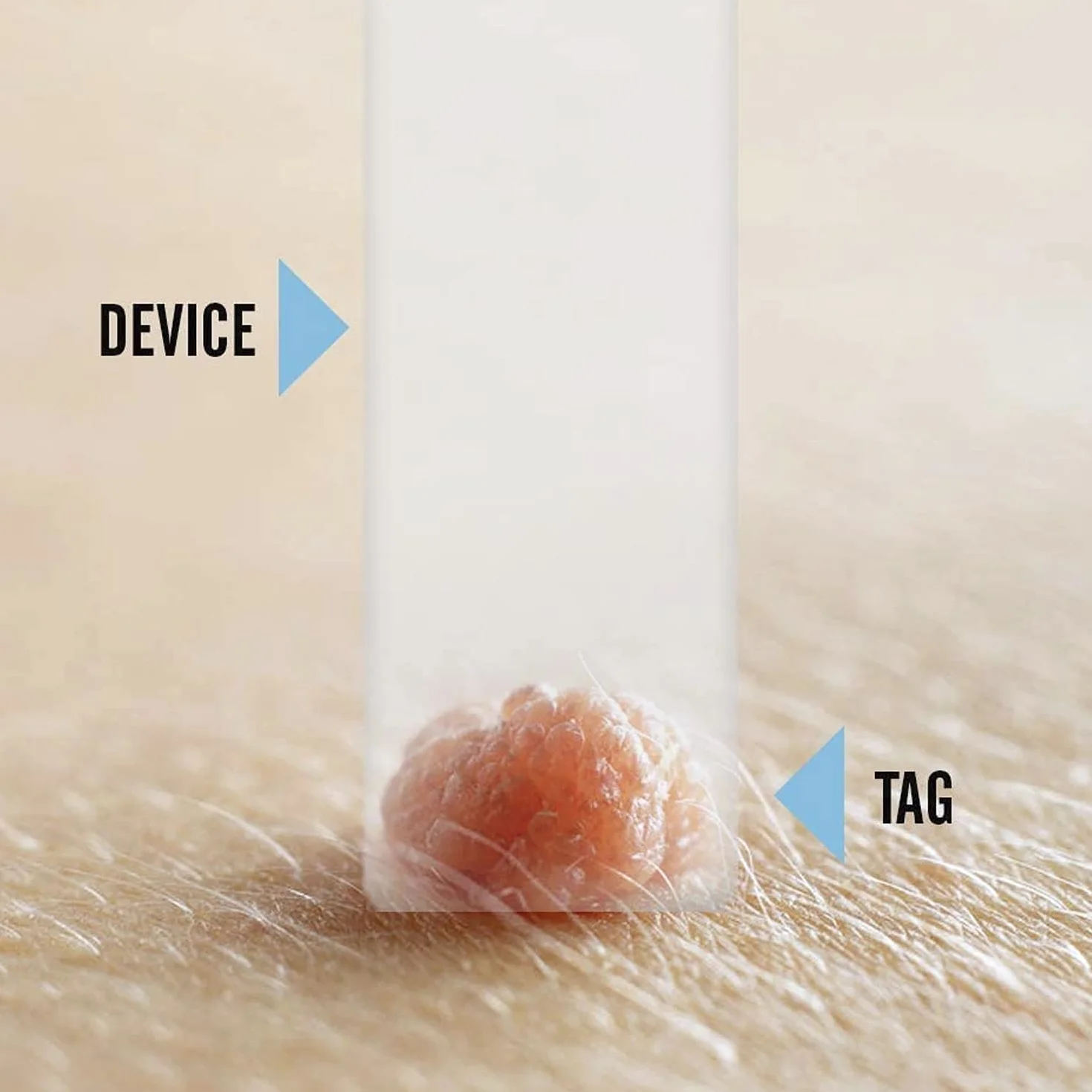 Bardzo mocny zestaw do usuwania włókniaków, brodawek lub wypukłości na skórze, delikatny dzięki mikro-opaskom/ Microband (zestaw startowy Tagcure z 10 mikro-opaskami)