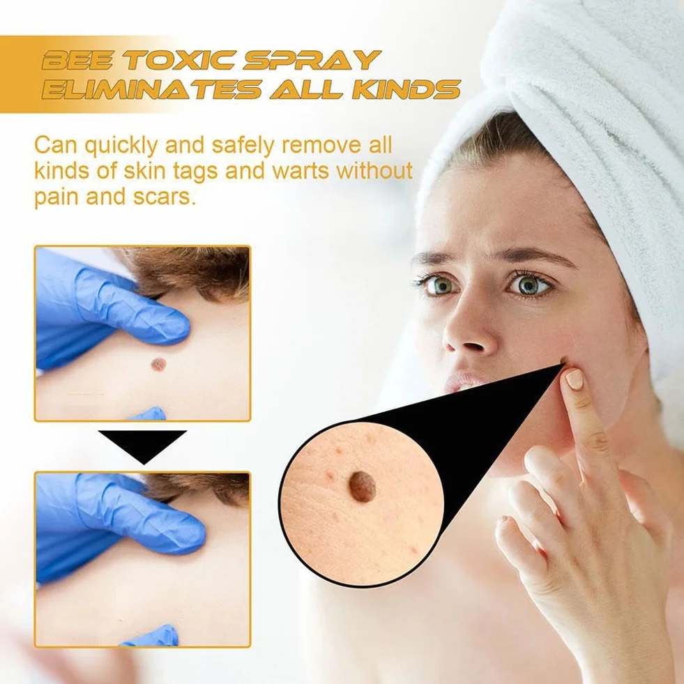 Tag Recede Bee Venom, spray do usuwania brodawek i znaczników jadu pszczół, spray do usuwania jadu pszczelego dla kobiet i mężczyzn, 20 ml/szt