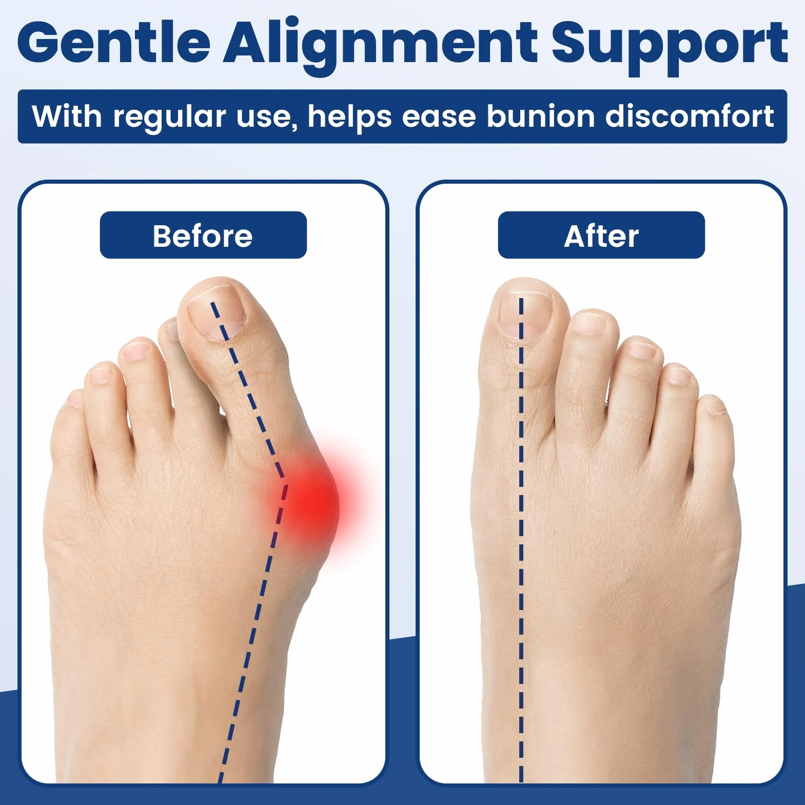 Hallux Valgus Taśmy Treningowe (3 szt), separatory palców do korekcji haluksów i łagodzenia bólu, korektor haluksów palce do treningu wyrównania i elastyczności