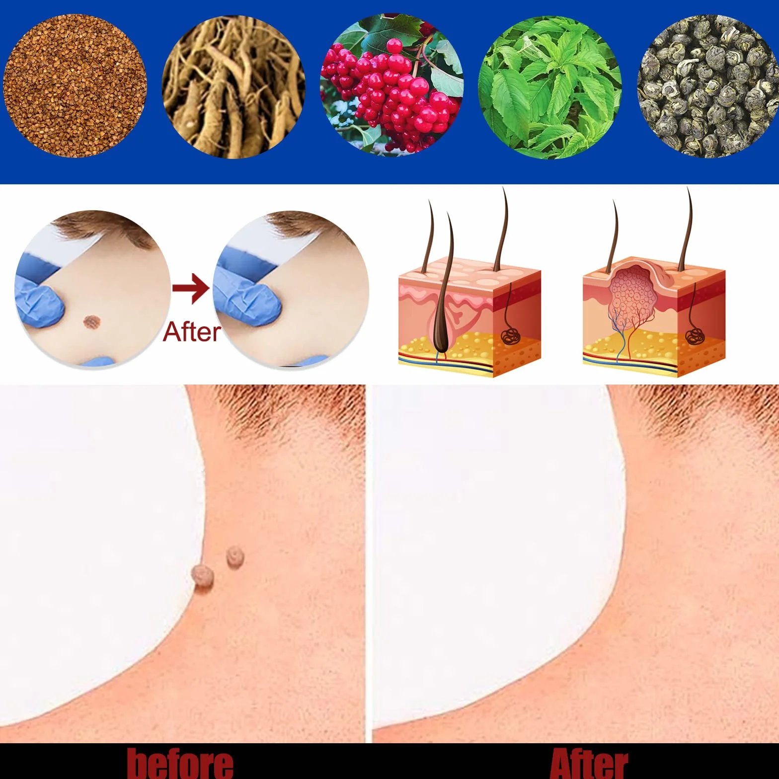 Skuteczny środek do usuwania brodawek – moc 20 g